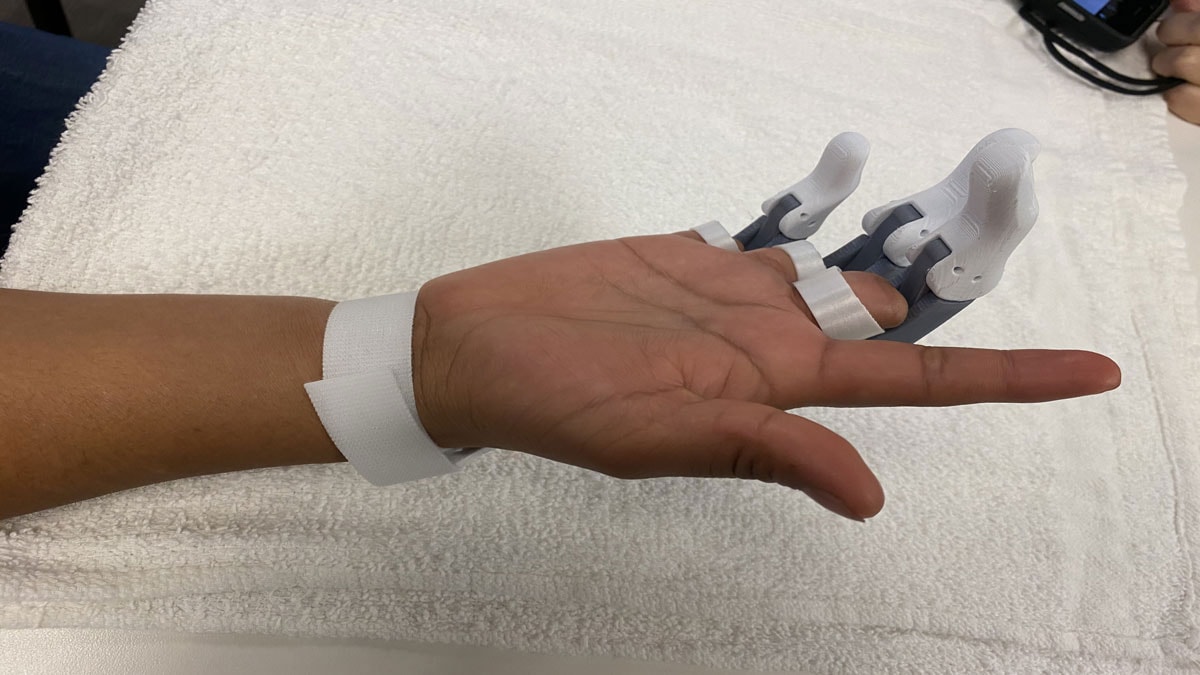 3D yazıcı ile parmak protezi yaptılar