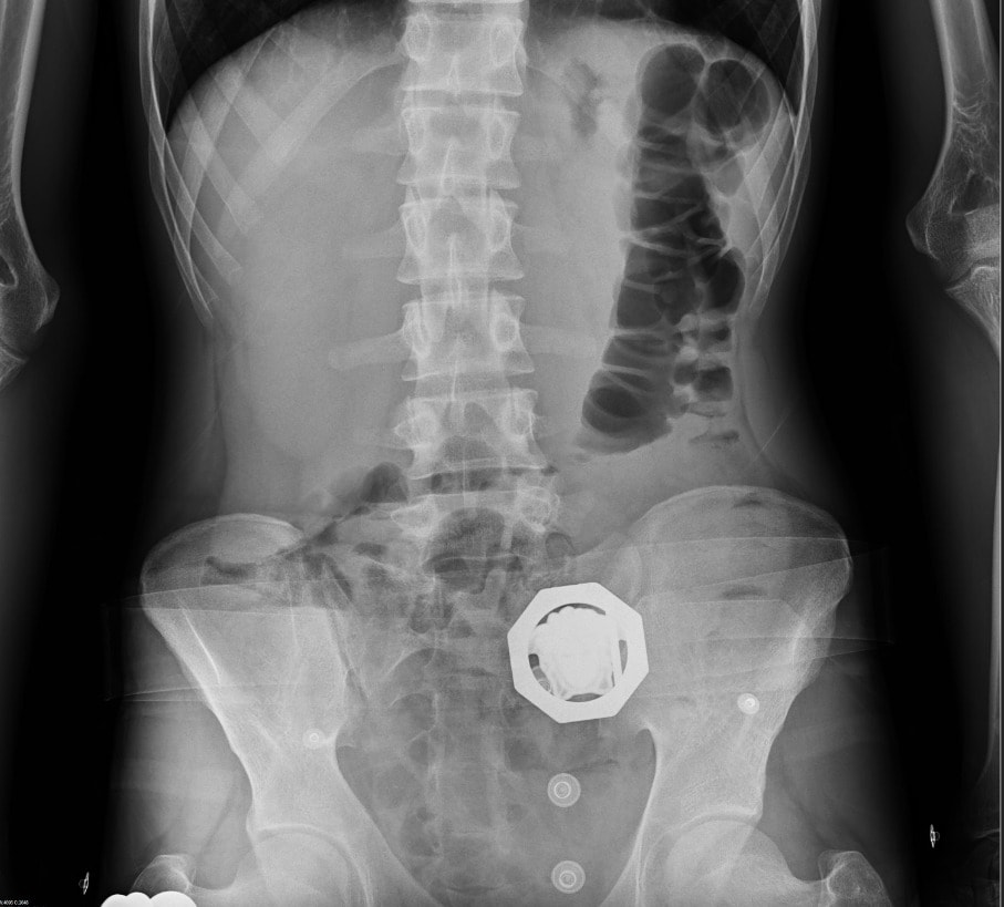 Eroin dolu mideyle 500 kilometre yol yaptılar