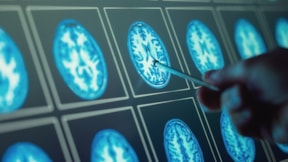 Bilimsel araştırma: Ölümcül beyin tümörlerine kan testiyle teşhis