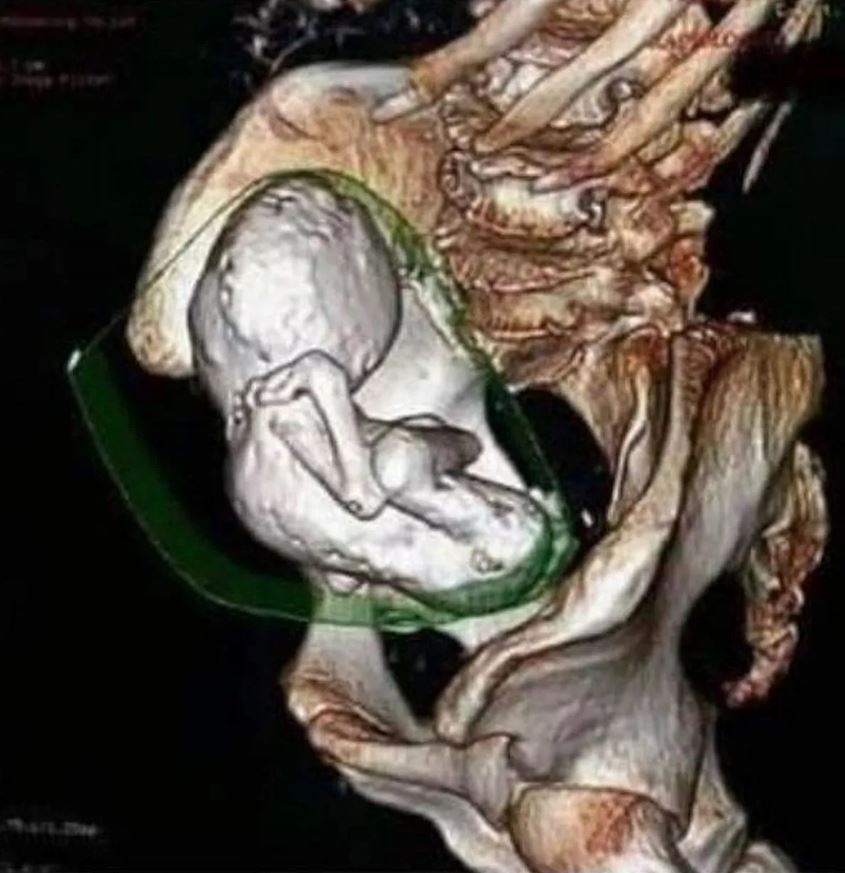 Şaşırtıcı olay: 35 yıl boyunca karnında bebekle yaşadı