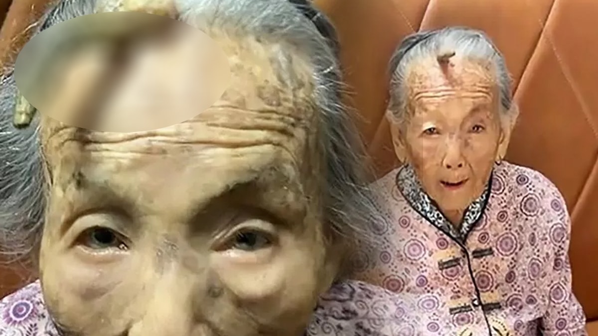 107 yaşında boynuzu çıktı! Doktorlar nedenini anlattı...