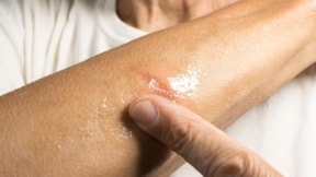 Yanığın üzerine sakın sürmeyin: Doktorlar, yapmanız gereken tek şeyi açıkladı