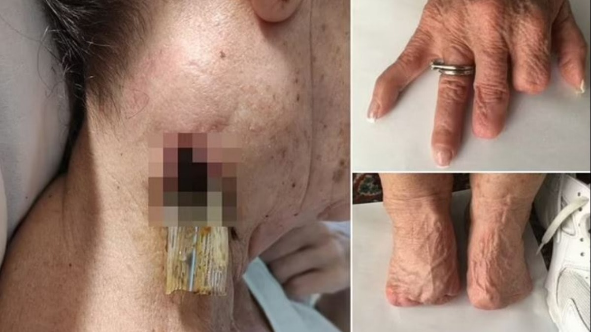 Ağrı kesici dehşeti: Hastalar ölüm ve amputasyonla karşı karşıya