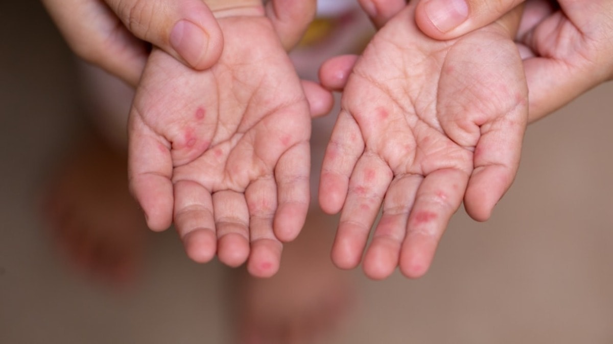 ABD şokta: THY uçağından inen yolcuda kızamık çıktı