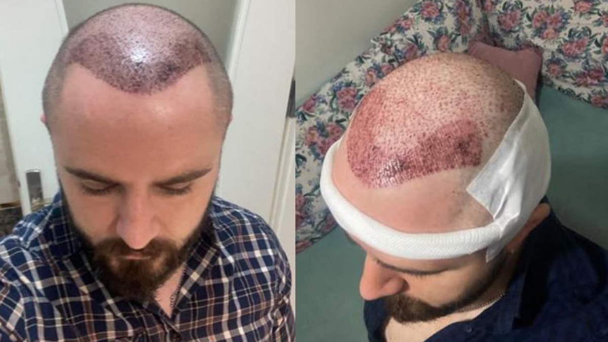 Saç ektirenler dikkat! Ya tutmazsa...