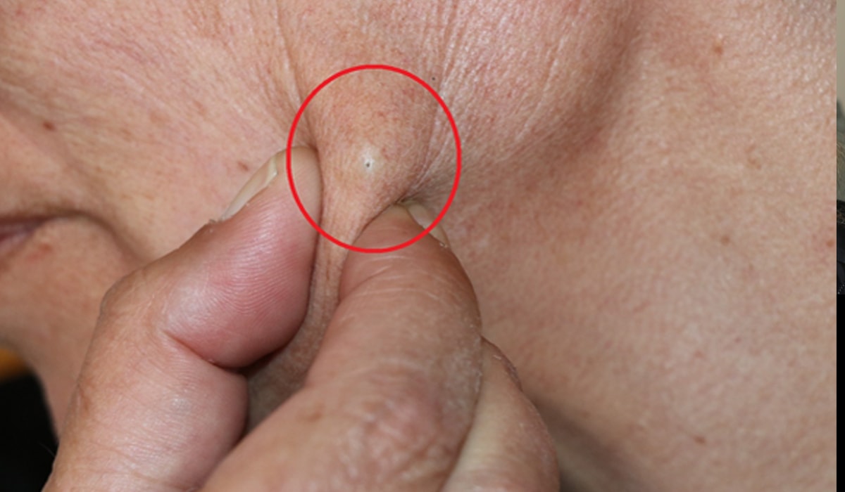 Komşu kavgasında sıkılan saçmalar yüzünde duruyor