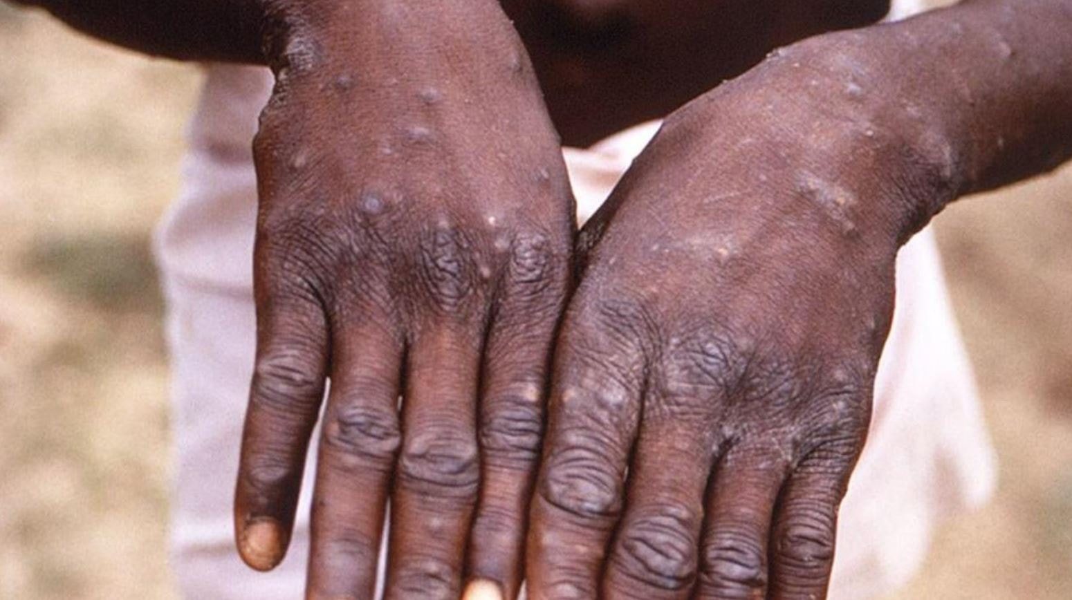 Maymun çiçeği virüsü yayılıyor! DSÖ'den dikkat çeken uyarılar