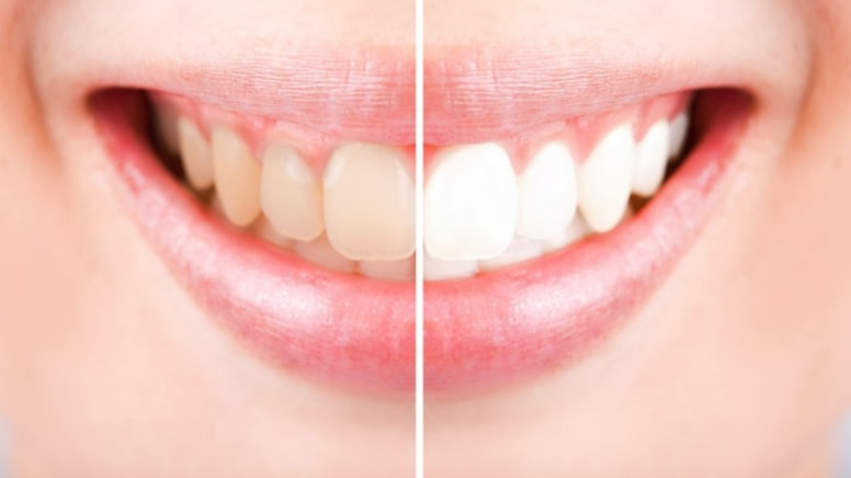 Sarı ve lekeli dişleri engelleyebilecek iki öneri
