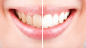 Sarı ve lekeli dişleri engelleyebilecek iki öneri