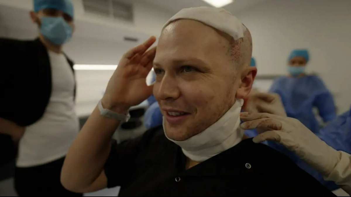 ABD'li gazeteci Türkiye'deki saç ektirme sürecinin tüm aşamalarını anlattı