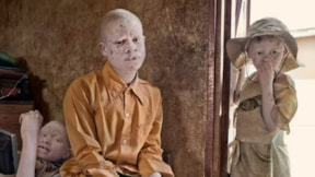Tanzanyalı albinolar zorlu yaşam koşullarıyla baş etmeye çalışıyor