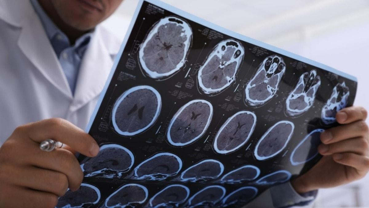 Alzheimer hastalığının genetiğiyle ilgili dikkat çekici araştırma