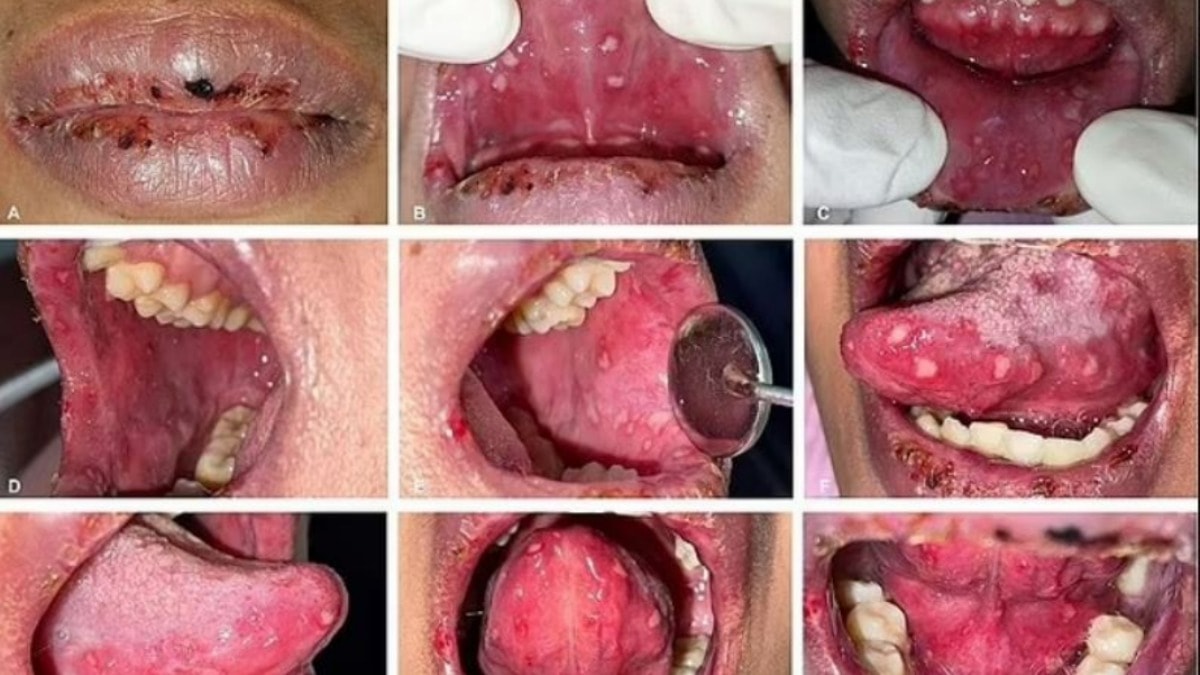 Korkutucu olay: E-sigara kanlı ağız yaralarına yol açtı