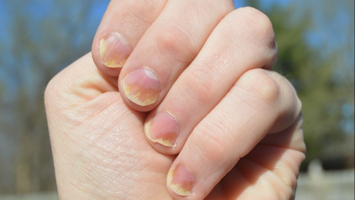 Tırnaklarda sararma neden olur?