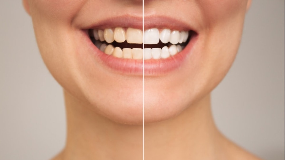 Diş beyazlatma nedir? Diş beyazlatma nasıl yapılır?