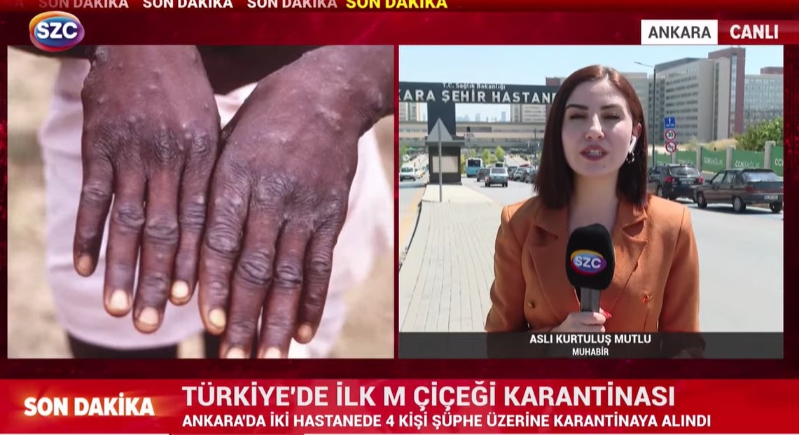 Ankara'da Maymun Çiçeği karantinası