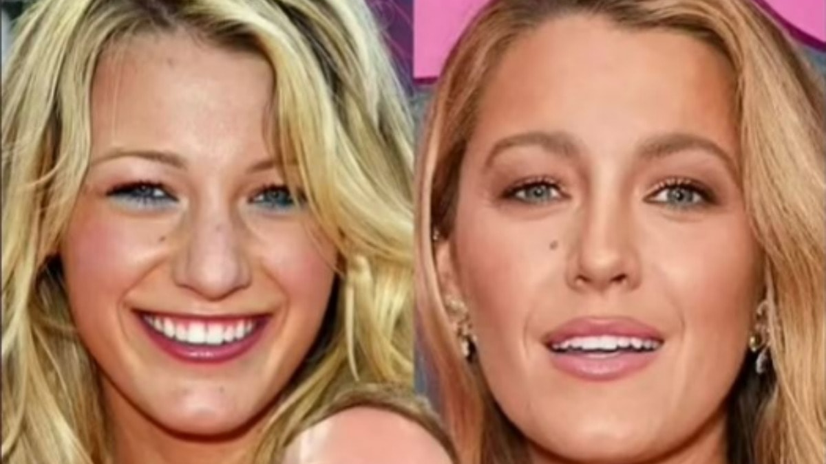 Blake Lively’nin estetik ameliyatla geçirdiği dönüşüm viral oldu