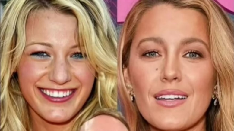Blake Lively’nin estetik ameliyatla geçirdiği dönüşüm viral oldu