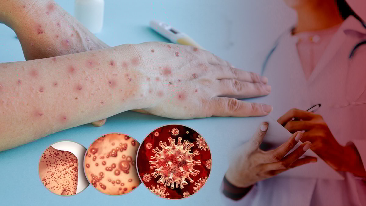 Maymun çiçeği virüsü nedir? Belirtileri nelerdir? Nasıl bulaşır? Tedavisi var mı?