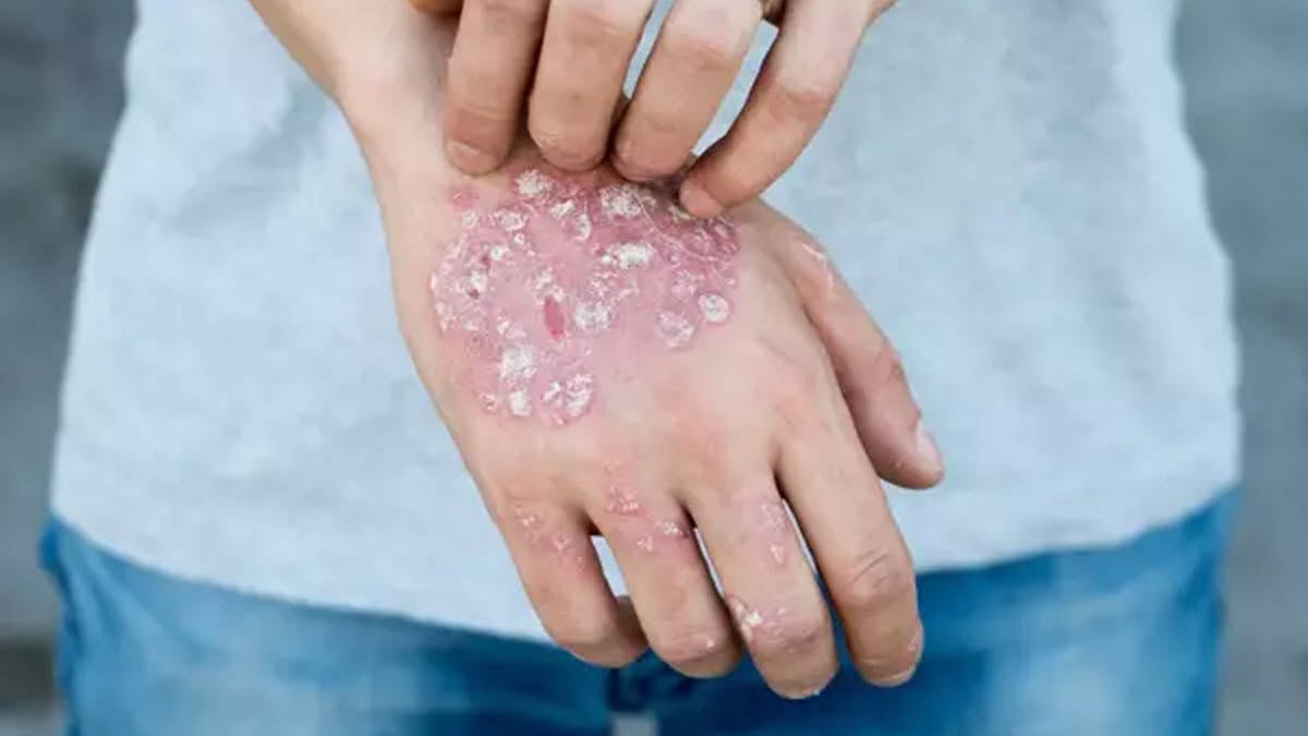 Sessiz tehlike kapıda: Mantar enfeksiyonları artıyor!