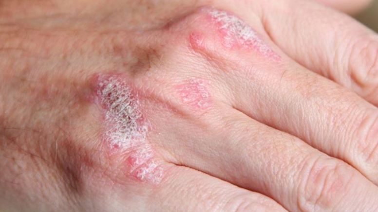 Meğer egzamayı tetikliyormuş!