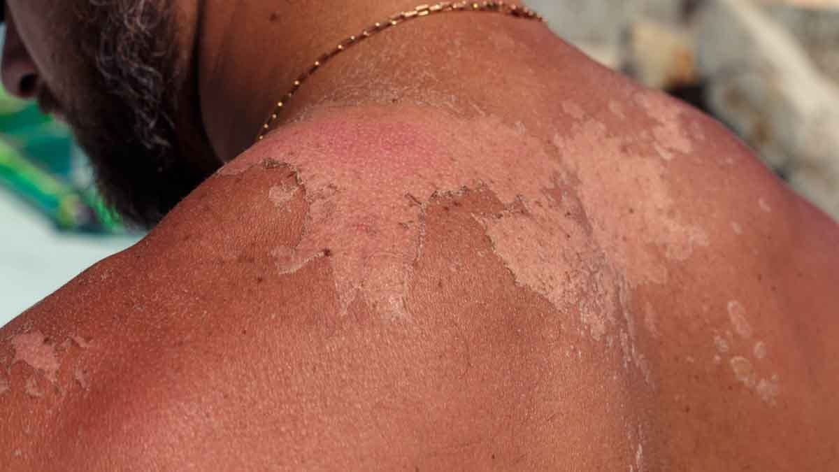 Güneş yanığının ana nedeni nihayet belirlendi: Ders kitapları yeniden yazılacak