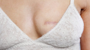 Memenin boyutu meme kanserinin habercisi: Uzmanlar kadınları uyardı