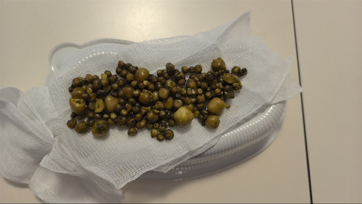 77 yaşındaki kadının safra kesesinden 213 tane taş çıkarıldı