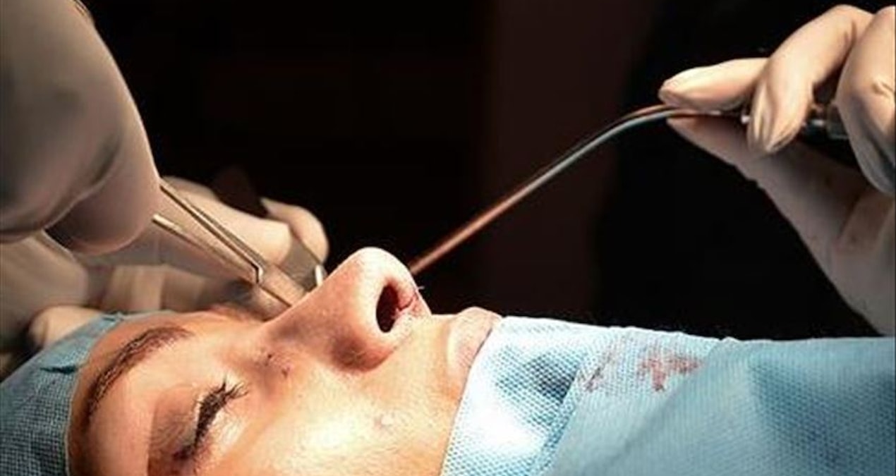 rinosjpg-ca5YmzngQka6F-mg8_JLBQ Rinoplasti hem estetik hem nefes sorunlarını düzeltiyor