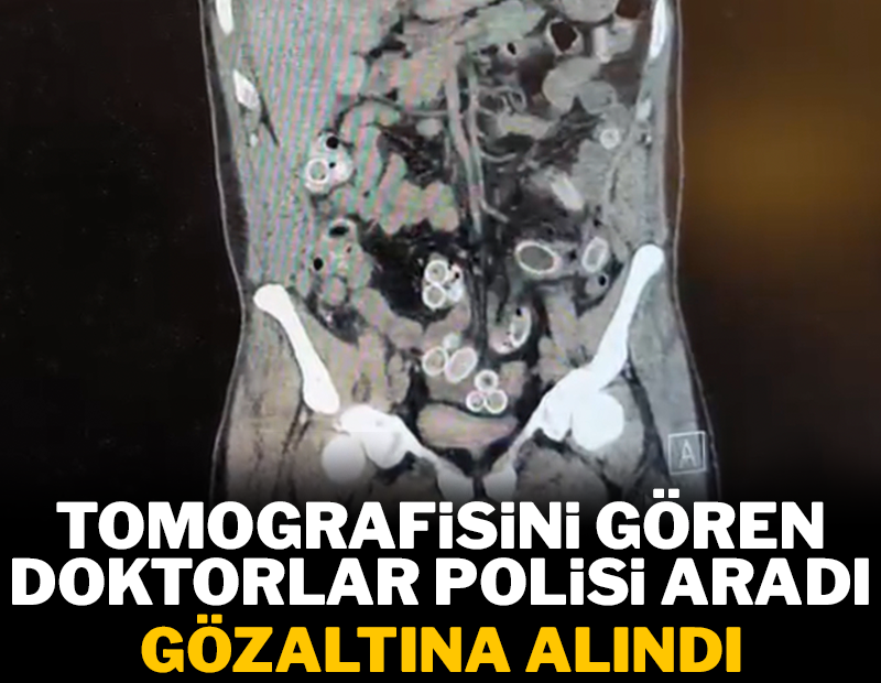 Tomografisini gören doktorlar polisi aradı, gözaltına alındı