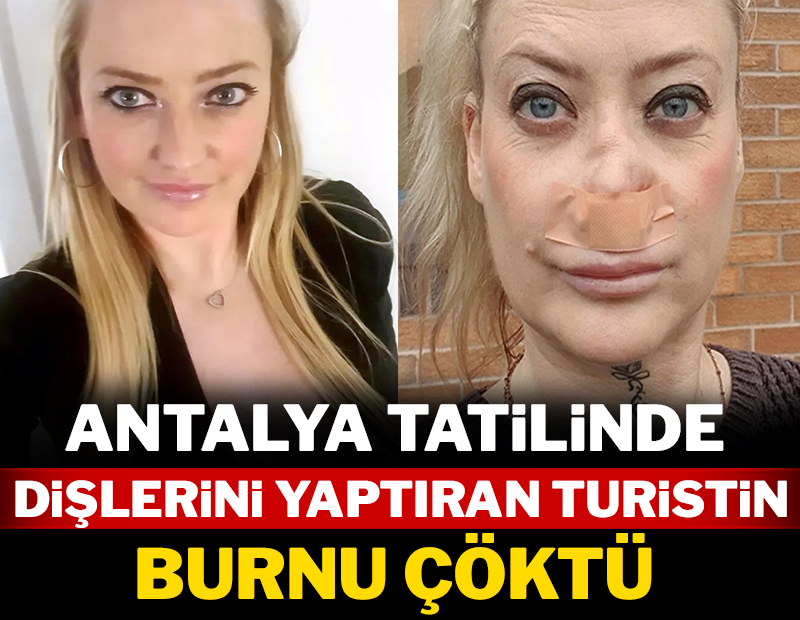 Antalya tatilinde dişlerini yaptıran turistin burnu çöktü!