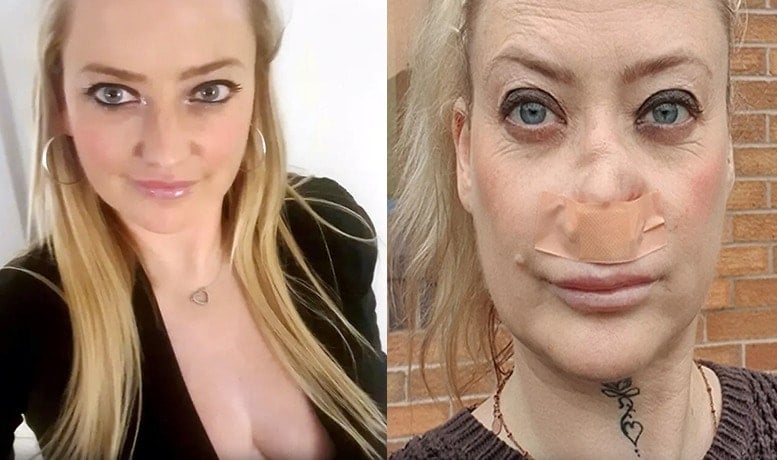 Antalya tatilinde dişlerini yaptıran turistin burnu çöktü!