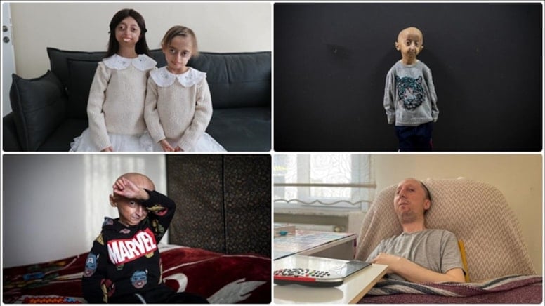 400 milyon kişiyi etkileyen nadir hastalıklar: İşte en ilginç vakalar