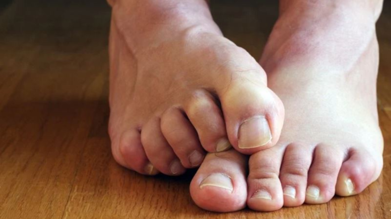 Mantar, tırnak batması meğer sessiz katilmiş: O hastalığın habercisi