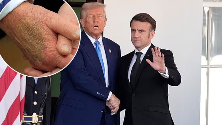 Trump'ın elindeki morluk dikkat çekti: Sağlığıyla ilgili ne saklanıyor?