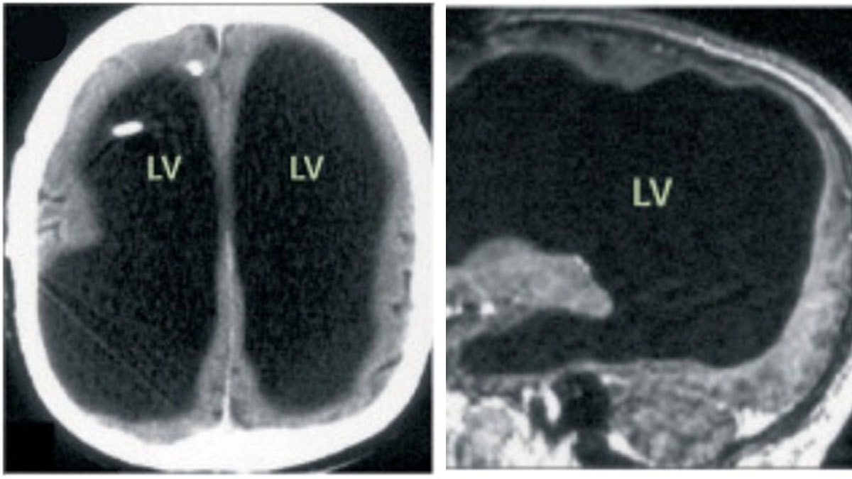 30 sene boyunca yarım beyinle yaşamış