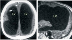 30 sene boyunca yarım beyinle yaşamış