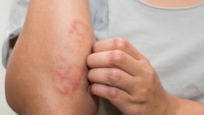 Erken tedavi edilmezse körlüğe neden oluyor