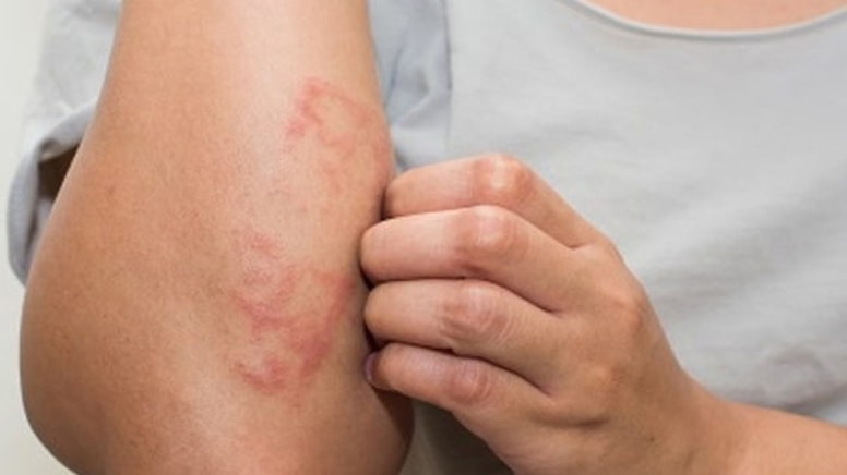 Erken tedavi edilmezse körlüğe neden oluyor