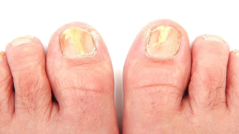 Zeytinyağı, sirke veya lavanta yağı değil: Ayak mantarını söküp atıyor, herkes kullanıyor