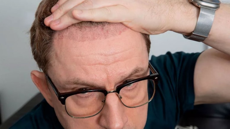 Saç ekimi hayatını mahvetti: İşinden oldu