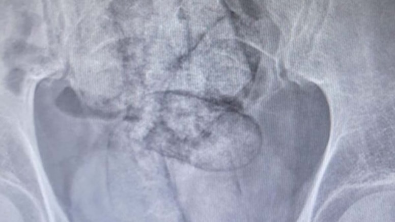 Artvin'de yakalanan İranlının midesinden çıktı, polisler inanamadı