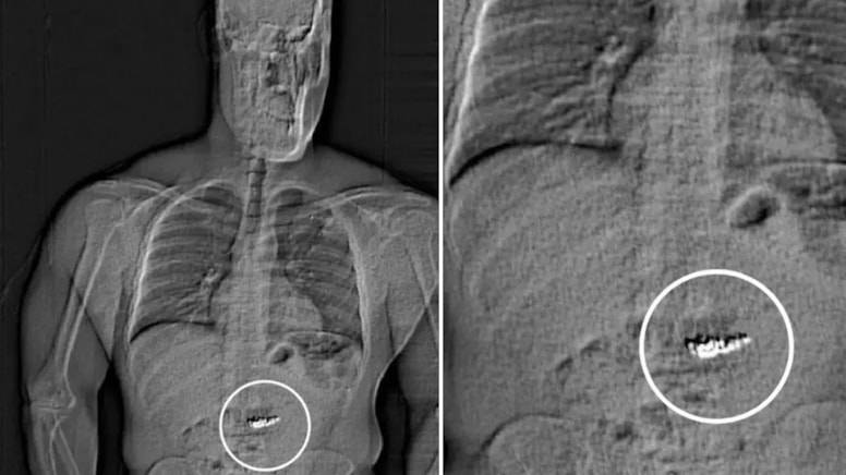 'Kusursuz planı' işlemedi: 28 milyon TL'lik küpeleri yutup kendini ele verdi