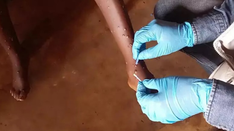 Uganda'da maymun çiçeği kabusu: Vaka sayısı artıyor