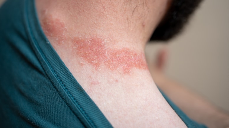 Yıllarca hastalığına çözüm bulamadı: Tek bir yöntemle kurtuldu!