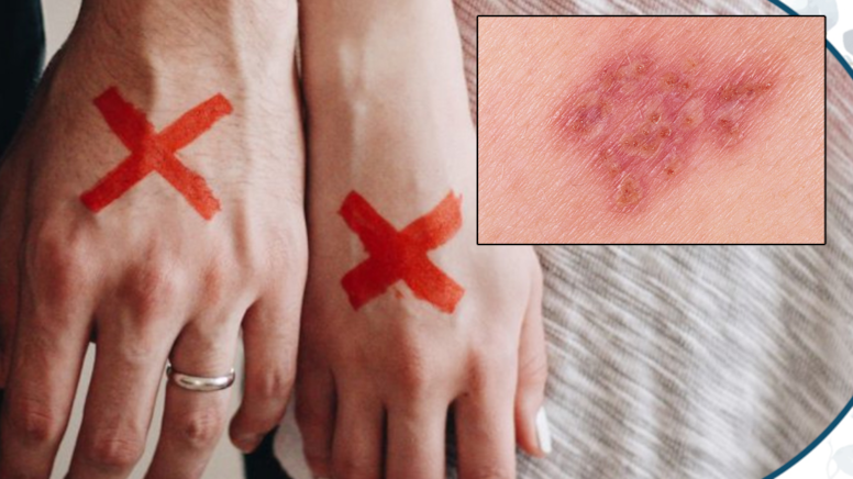 'Deri yiyen mantar' yanı başımıza geldi: Doktorlar alarmda