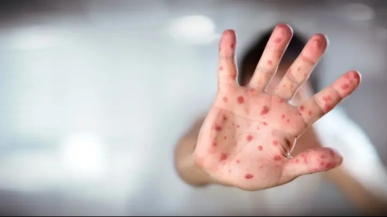 Kızamık vakaları artıyor: Teksas'ta 500'e yükseldi