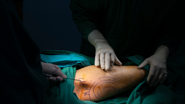 Estetikten 1 gün sonra hayatını kaybetti: Herkes yaptırıyor ama riskli