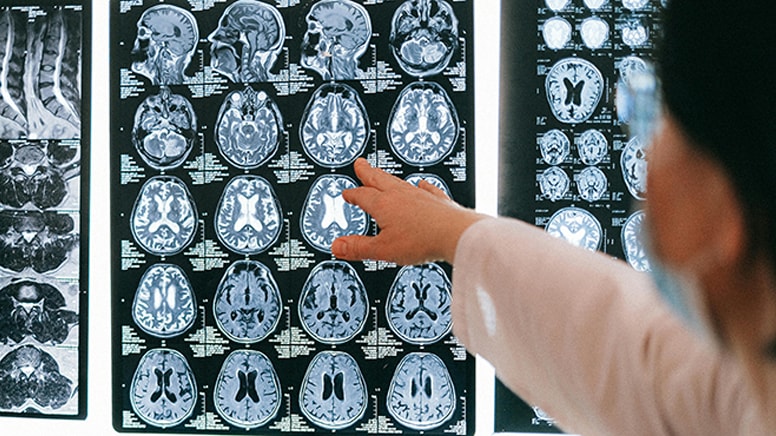 Mikroplastik yiyoruz! Sadece beyinde miktarı yüzde 50 artmış