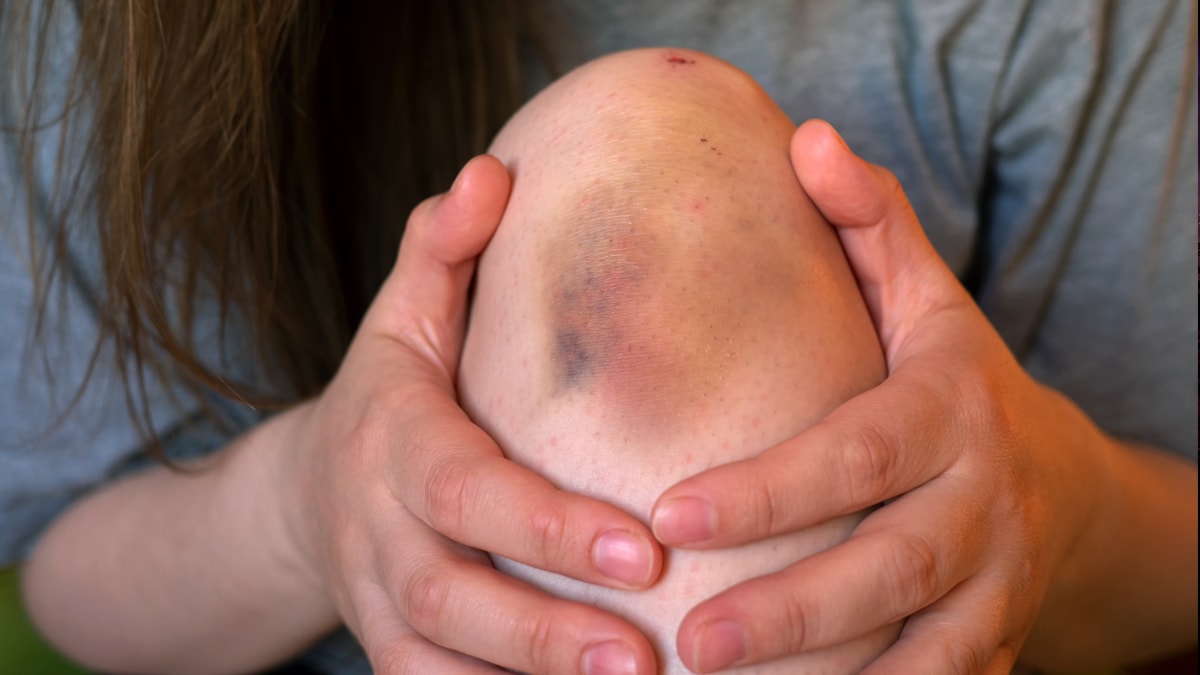 Çocuklarda morluk ve kanama uyarı sinyali olabilir